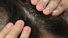 Schampo behövs inte: säg hejdå till mjäll med en krydda som finns i varje hem